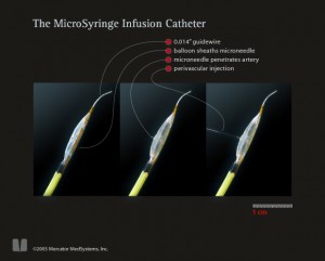 Mercator's adventitial delivery technology