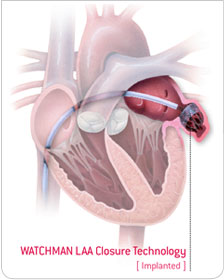 laa_closure