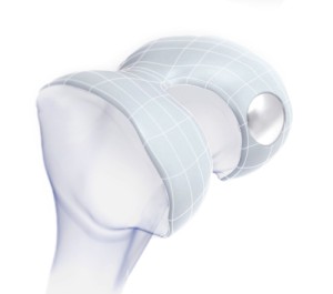 Episealer cartilage replacement device