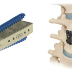 Biomet Enhances Spinal Portfolio with Acquisition of Lanx
