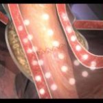 New Study Says Stretta is Valuable GERD Treatment
