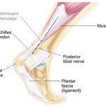 Positive Long Term Outcomes for Tiny Injectable Incontinence Treatment Device