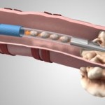 Medtronic’s New Biopsy System Targets Improved Lung Cancer Diagnosis
