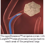 GPS Technology May Help Physicians Detect Lung Cancer Early