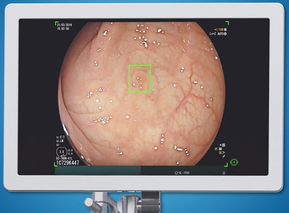 AI improves polyp detection
