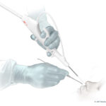 FDA Clearance for 3NT Peregrine™ Sinus Endoscope
