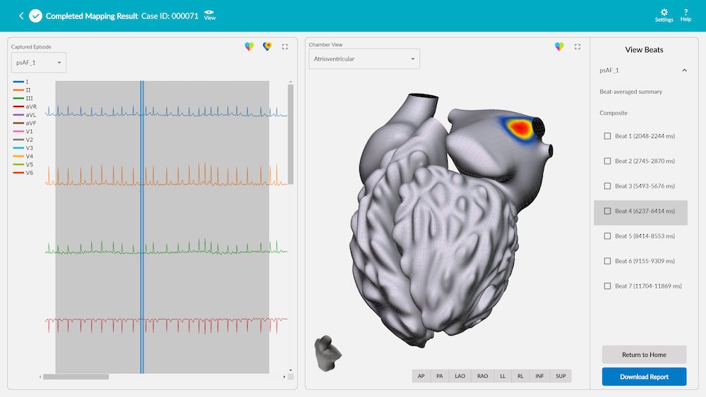 vMap screen displays arrhythmia hot spots, using data derived from 12 lead ECG