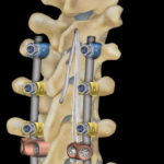 FDA Clears First Spine Device for Ligament Augmentation